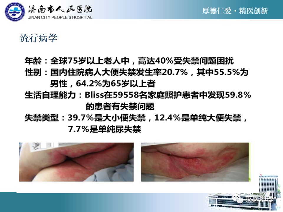 解读失禁性皮炎最新指南（2021版），诊疗与护理策略聚焦