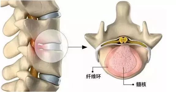 腰椎间盘突出最新疗法，探索前沿技术与治疗希望